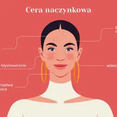 Cera naczynkowa: 7 objawów, które musisz znać - Poradnik