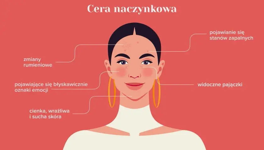 Cera naczynkowa: 7 objawów, które musisz znać - Poradnik