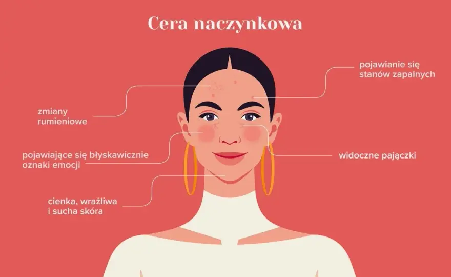 Cera naczynkowa: 7 objawów, które musisz znać - Poradnik